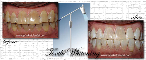 Tooth Whitening:Coldlight,non-LASER,LED,Natural Plus at Phuket Dental Clinic,Thailand